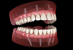 A 3D illustration of all-on-4 dentures
