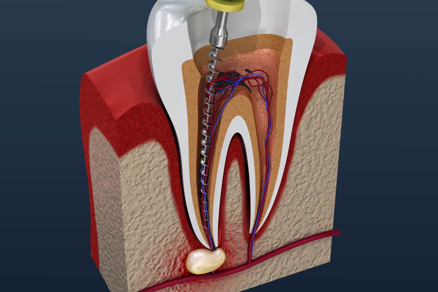 Does Your Tooth Hurt? A Dentist Explains When Root Canal Therapy Is Needed